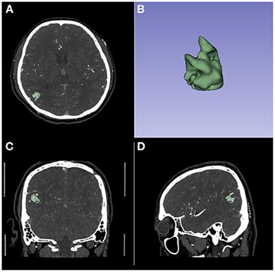 Development and validation of a model for predicting the risk of brain arteriovenous malformation rupture based on three-dimensional morphological features